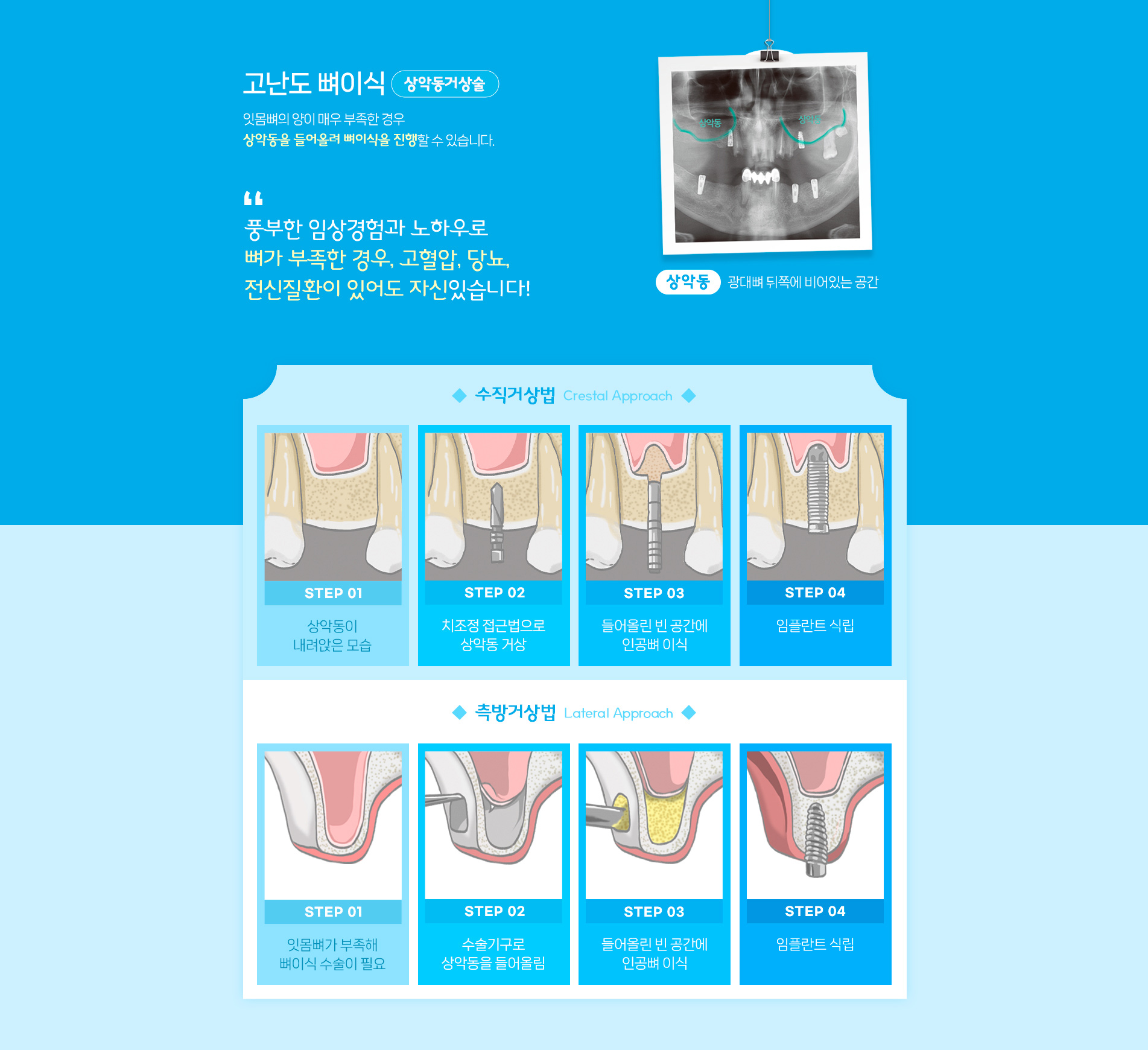 고난도 뼈이식